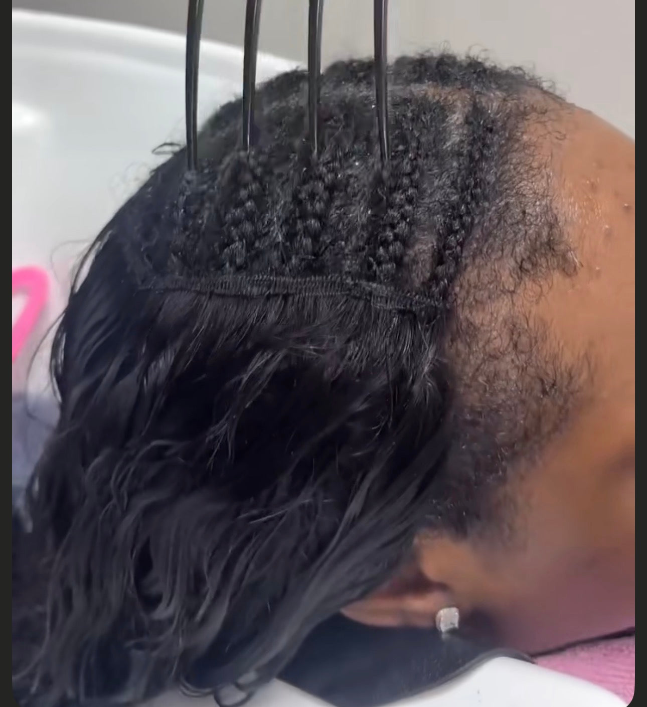 All hair removals